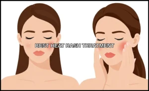 Best heat rash treatment