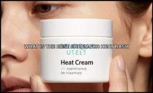 The best cream for heat rash